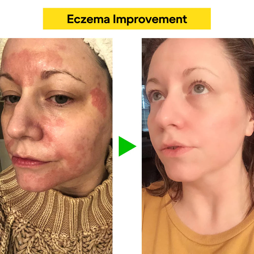 East Asia Eczema & Psoriasis Natural Herbal Cream (Copy)