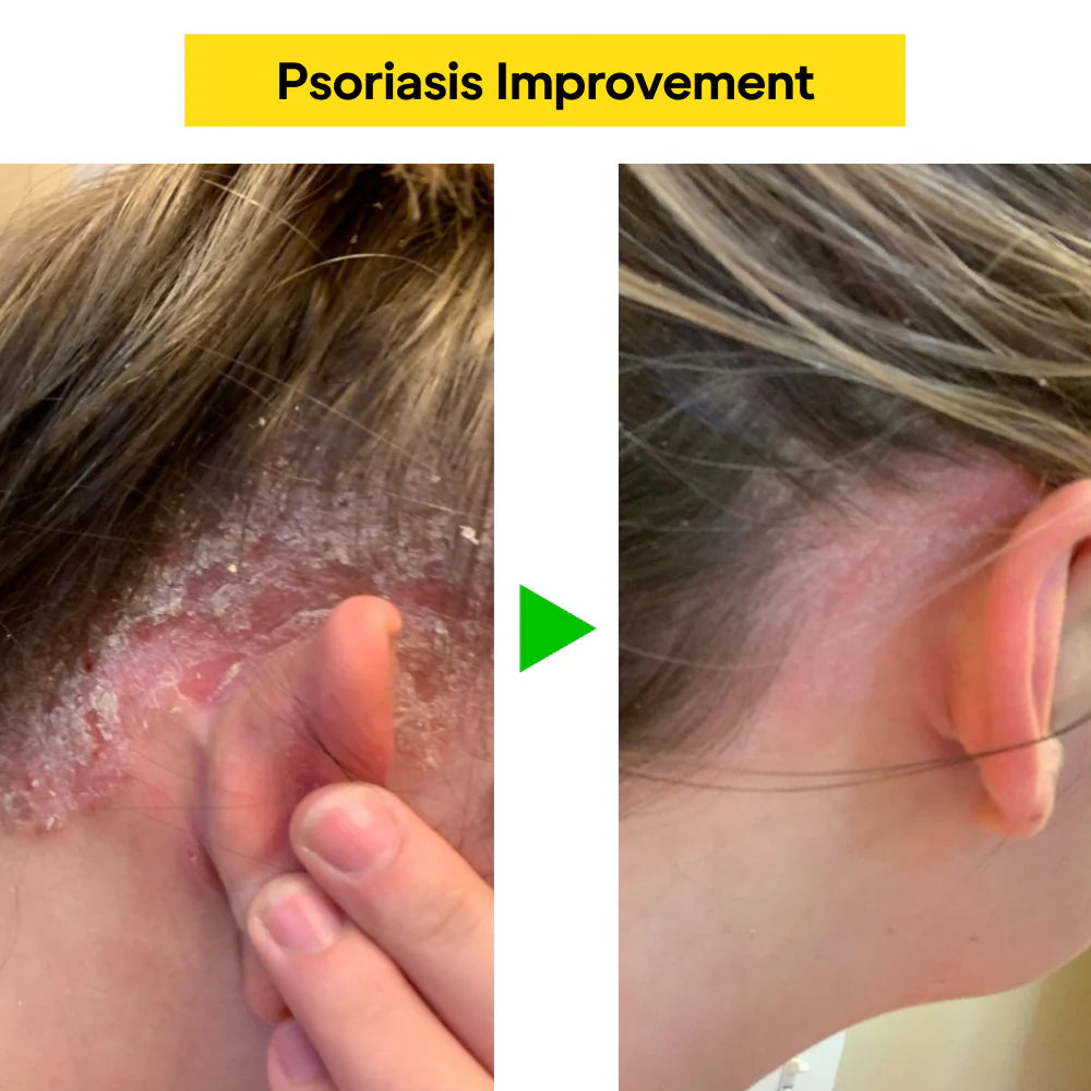 East Asia Eczema & Psoriasis Natural Herbal Cream (Copy)